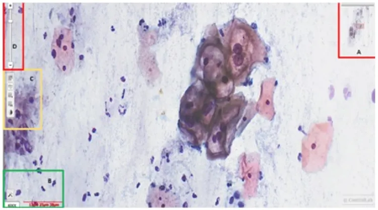 Detecção Automática de Lesões Cervicais em Esfregaços de Papanicolau